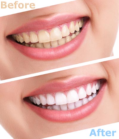 before and after teeth whitening results of services offered at Pacific Coast Dentistry in Paso Robles, CA