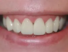 After image