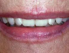 After image