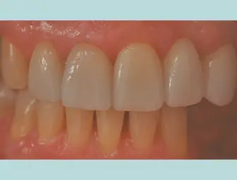 After image