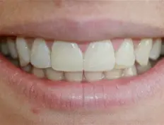 After image