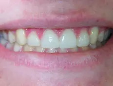 After image