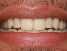 After image