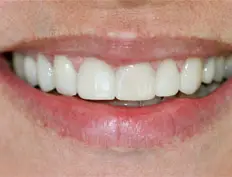 After image