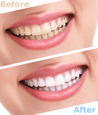 before and after teeth whitening results of services offered at Pacific Coast Dentistry in Paso Robles, CA